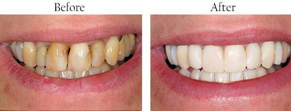 Before and after teeth whitening comparison, showcasing a significant improvement in tooth color.