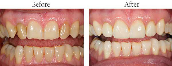 The image shows a before and after comparison of teeth whitening, with the top half showing teeth discoloration and the bottom half displaying the same teeth after treatment.