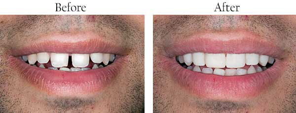 Before and after comparison of dental implant procedure.