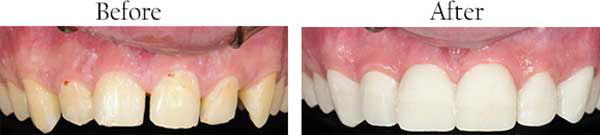 The image shows a before-and-after comparison of dental treatment, with the left side showing a patient s teeth in need of repair and the right side displaying the same teeth after treatment.