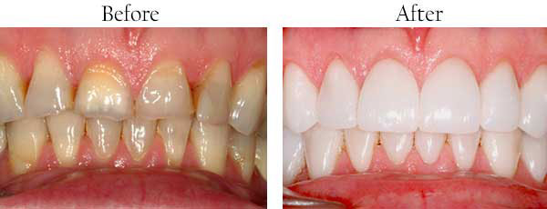 The image shows a before-and-after comparison of dental teeth whitening, with the top half showing discolored teeth and the bottom half displaying a brighter, whiter smile after treatment.