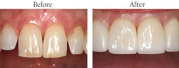 The image shows a before-and-after comparison of dental work, with the  before  side showing a set of teeth with visible staining and discoloration, and the  after  side displaying the same teeth after professional cleaning or whitening treatment.