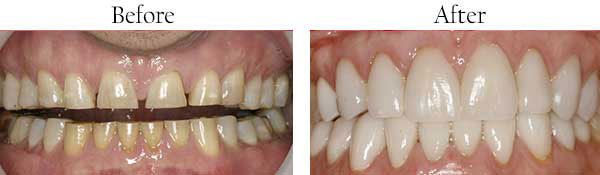 The image shows a before and after comparison of teeth whitening, with the  before  side showing yellowed teeth and the  after  side showing significantly whiter teeth.