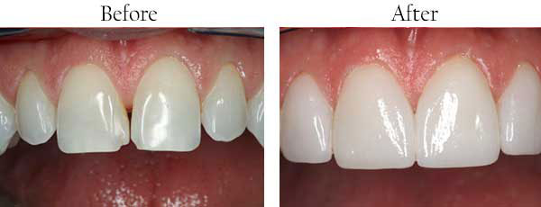 The image shows a before and after view of teeth whitening, with the top half showing discolored teeth and the bottom half displaying a brighter, whiter smile.